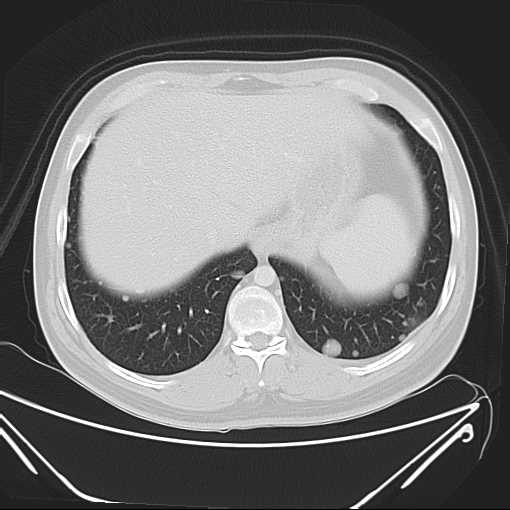 File:Cannonball pulmonary metastases (Radiopaedia 67684-77101 Axial lung window 22).jpg