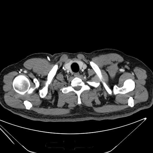 File:Cannonball pulmonary metastases (Radiopaedia 67684-77101 D 7).jpg