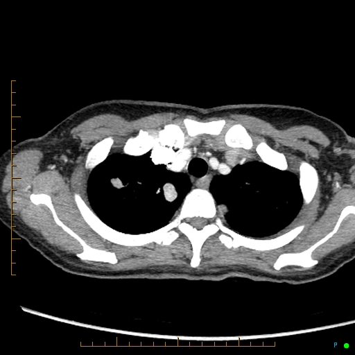 Canonball lung metastasis (Radiopaedia 77634-89837 B 12).jpg