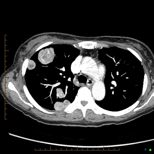 Canonball lung metastasis (Radiopaedia 77634-89837 B 31).jpg