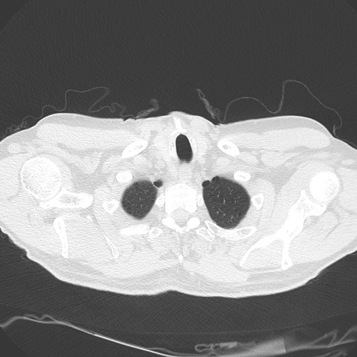 Caplan syndrome (Radiopaedia 56667-63530 Axial lung window 21).jpg