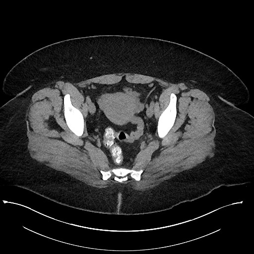 File:Carcinoid tumor - terminal ileum (Radiopaedia 60931-68740 Axial non-contrast 106).jpg