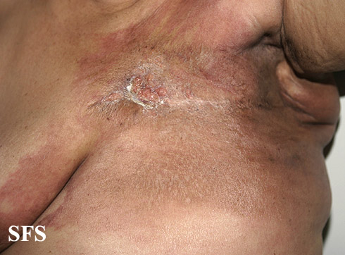 Carcinoma Erysipeloides (Dermatology Atlas 5).jpg