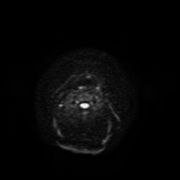 File:Carcinoma ex-pleomorphic adenoma of parotid (Radiopaedia 28383-28627 Ax DWI B-500 GE 41).jpg