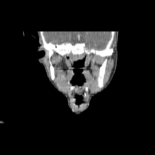 Carcinoma of the maxillary antrum (Radiopaedia 53805-59888 Coronal C+ delayed 83).jpg
