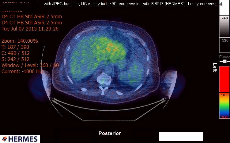 File:Cardiac lymphoma (Radiopaedia 38690-40871 Integrated PET-CT 21).jpg
