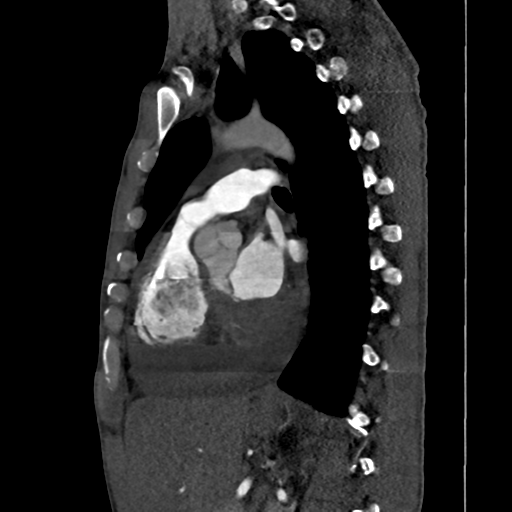 Cardiac tumor - undifferentiated pleomorphic sarcoma (Radiopaedia 45844-50134 B 32).png
