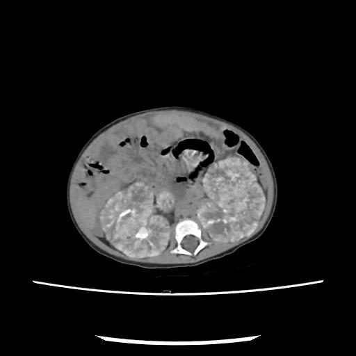 Caroli disease with autosomal recessive polycystic kidney disease (ARPKD) (Radiopaedia 89651-106703 E 115).jpg