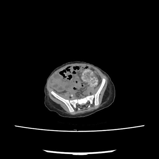 Caroli disease with autosomal recessive polycystic kidney disease (ARPKD) (Radiopaedia 89651-106703 E 186).jpg