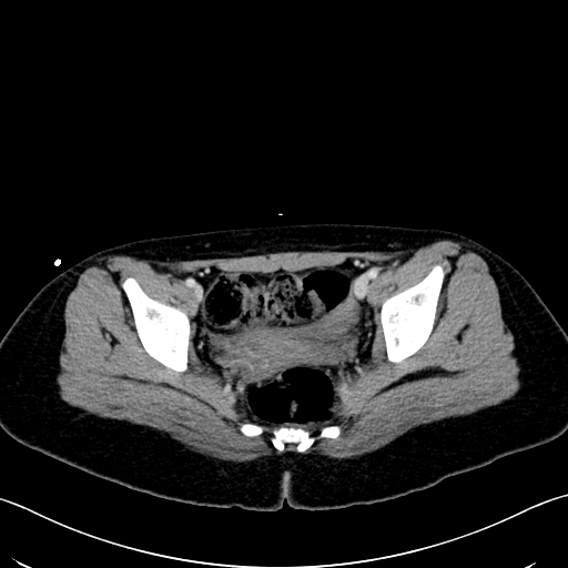 Caroli disease with medullary sponge kidney (Radiopaedia 82622-96804 C 68).jpg