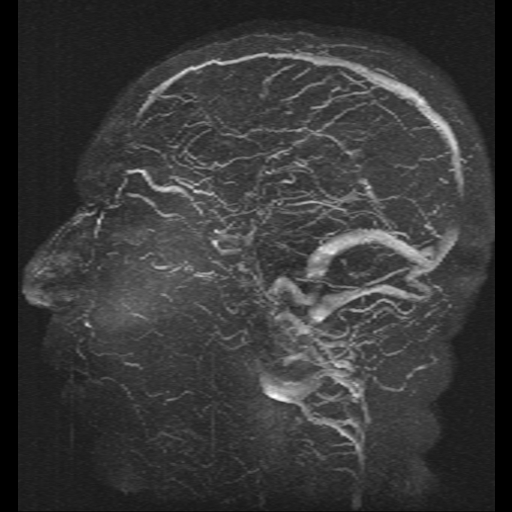 File:Carotid arterial dissection with acute cerebral infarction (Radiopaedia 26636-26784 MRV 3).jpg