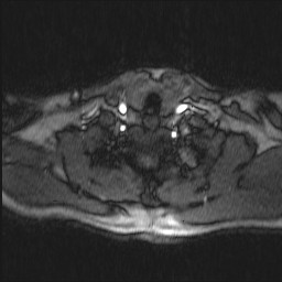 File:Carotid artery dissection (Radiopaedia 28441-28689 Axial MRA 14).jpg