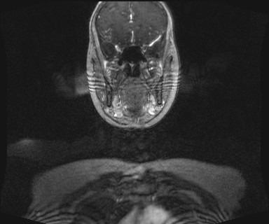 Carotid body tumor (Radiopaedia 12777-12912 MRA 13).jpg