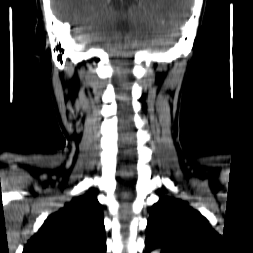 File:Carotid body tumor (Radiopaedia 27890-28124 B 2).jpg