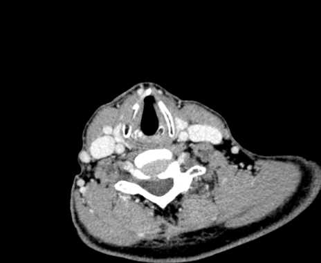 Carotid body tumor (Radiopaedia 61750-69757 Axial Post contrast 83).jpg