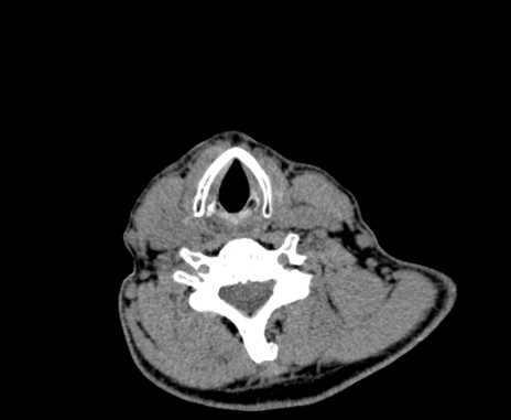 Carotid body tumor (Radiopaedia 61750-69757 Axial non-contrast 77).jpg