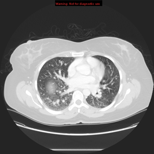 Carotid body tumor with lung metastases (Radiopaedia 9301-48390 Axial lung window 39).jpg