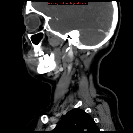 Carotid body tumor with lung metastases (Radiopaedia 9301-9986 Sagittal C+ delayed 12).jpg