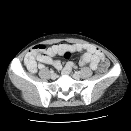 Castleman disease with fibrous pseudotumor in the abdomen (Radiopaedia 77296-89373 A 89).jpg