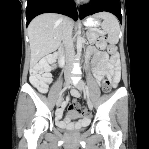 Castleman disease with fibrous pseudotumor in the abdomen (Radiopaedia 77296-89373 B 49).jpg