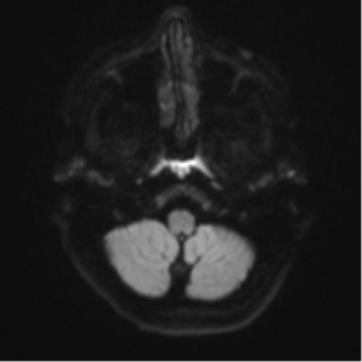 File:Cavernoma with bleed - midbrain (Radiopaedia 54546-60774 Axial DWI 31).png