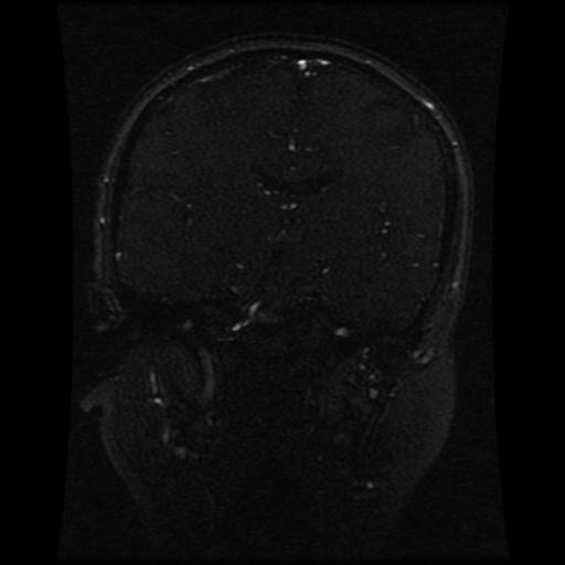 Cavernoma with developmental venous anomaly (Radiopaedia 22470-22507 MRV 71).jpg