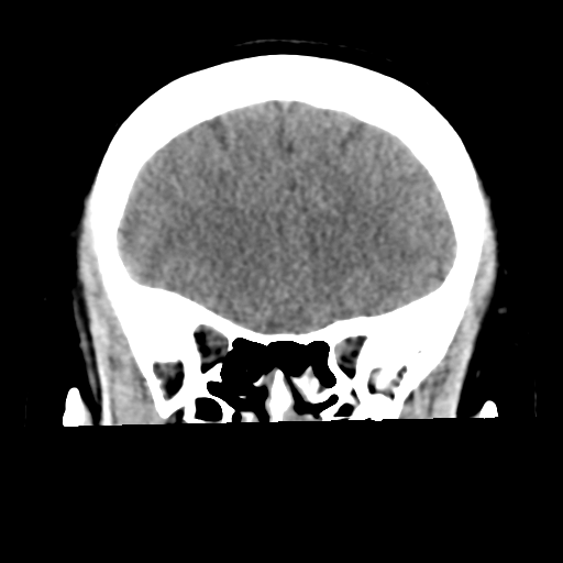 Cavernoma with hemorrhage (Radiopaedia 70755-80931 Coronal non-contrast 19).png