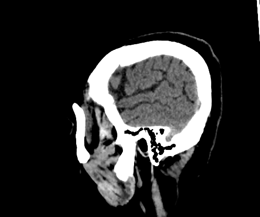 Cavernous hemangioma of the cerebellar falx (Radiopaedia 73025-83723 B 49).jpg