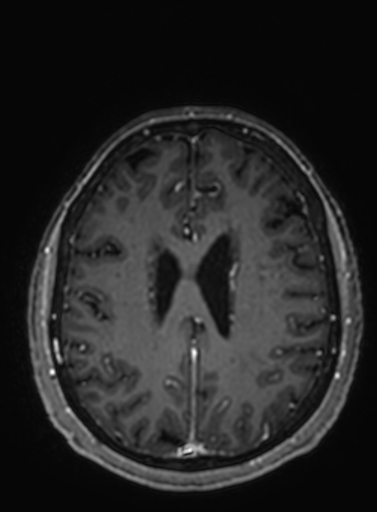Cavernous hemangioma of the cerebellar falx (Radiopaedia 73025-83724 Axial T1 C+ 113).jpg
