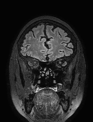 Cavernous hemangioma of the cerebellar falx (Radiopaedia 73025-83724 Coronal FLAIR 75).jpg