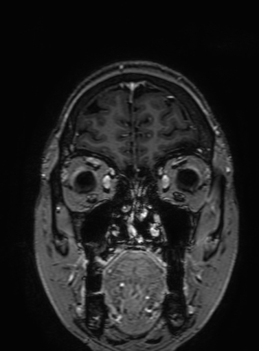 Cavernous hemangioma of the cerebellar falx (Radiopaedia 73025-83724 Coronal T1 C+ 63).jpg