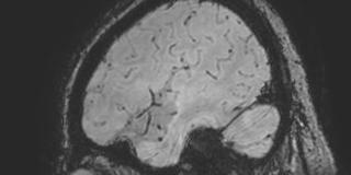 Cavernous hemangioma of the cerebellar falx (Radiopaedia 73025-83724 Sagittal BOLD 170).jpg