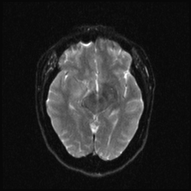 Cavernous sinus meningioma (Radiopaedia 63682-72367 DWI 11).jpg