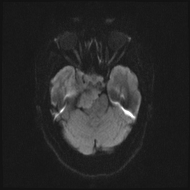 File:Cavernous sinus meningioma (Radiopaedia 63682-72367 DWI 48).jpg