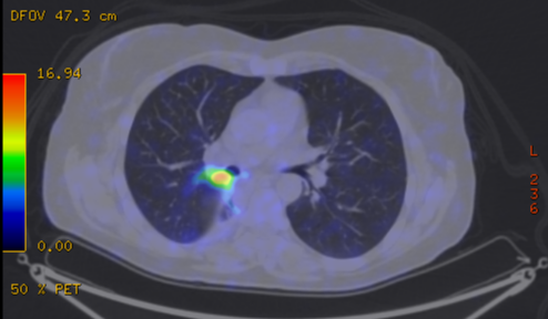 File:Cavitating lung mass - squamous cell carcinoma (Radiopaedia 48047-52853 A 45).png