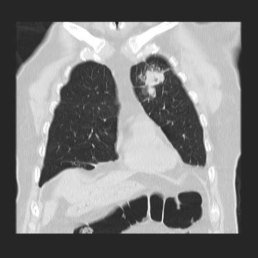 File:Cavitating pulmonary metastases (Radiopaedia 89545-106544 Coronal lung window 11).jpg