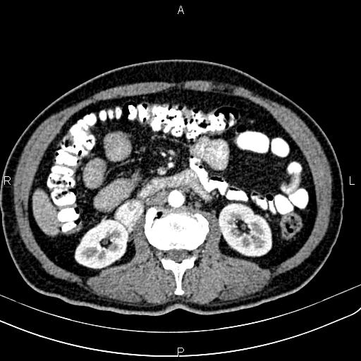 File:Cecal cancer with appendiceal mucocele (Radiopaedia 91080-108651 A 87).jpg