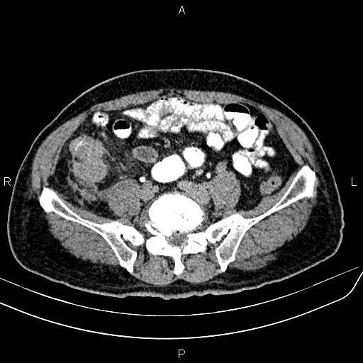 File:Cecal cancer with appendiceal mucocele (Radiopaedia 91080-108651 Axial C+ delayed 53).jpg