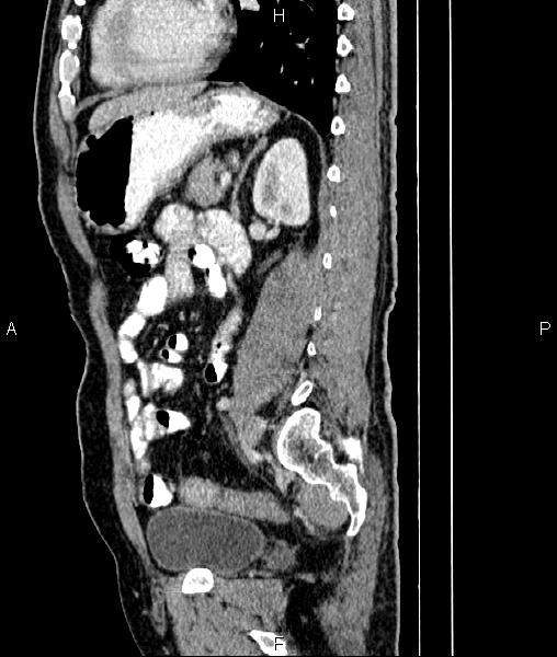 File:Cecal cancer with appendiceal mucocele (Radiopaedia 91080-108651 E 62).jpg