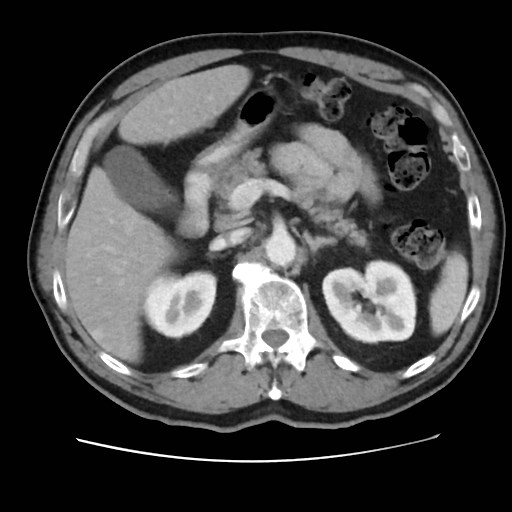 Cecal mass causing appendicitis (Radiopaedia 59207-66531 A 29).jpg