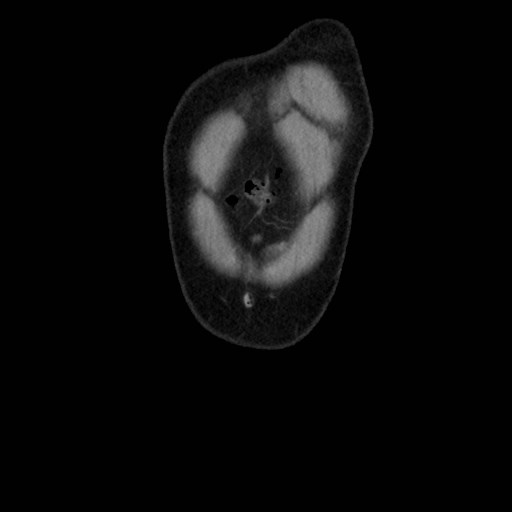 File:Cecal mass causing appendicitis (Radiopaedia 59207-66531 B 1).jpg