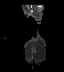 Cecal volvulus (Radiopaedia 86741-102900 B 2).jpg