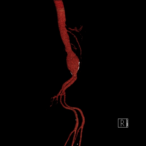 File:Celiac artery compression by the diaphragmatic crurae (Radiopaedia 31739-32666 3D CTA 5).jpg