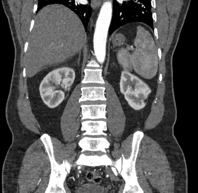 Celiac artery dissection (Radiopaedia 52194-58080 C 106).jpg