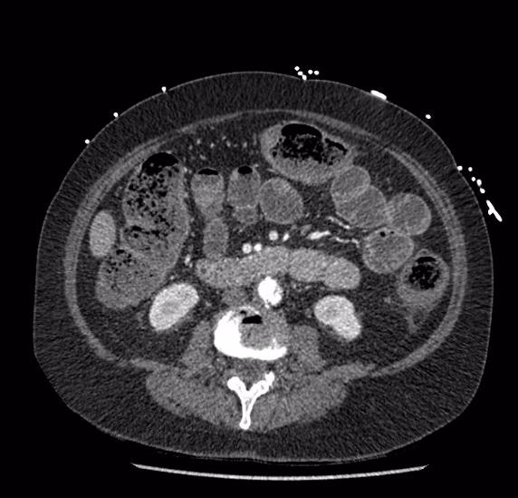 File:Celiac artery severe stenosis and dissection (Radiopaedia 44128-47842 B 49).jpg