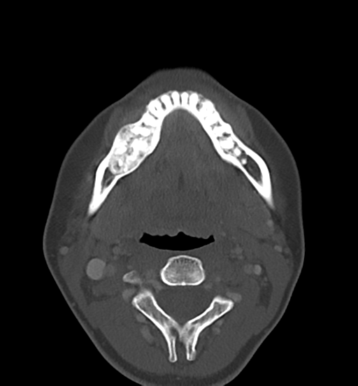 Cemento-ossifying fibroma (Radiopaedia 46243-50643 Axial bone window 43).png