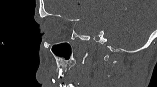 File:Central giant cell granuloma (Radiopaedia 83346-97761 Sagittal bone window 33).jpg