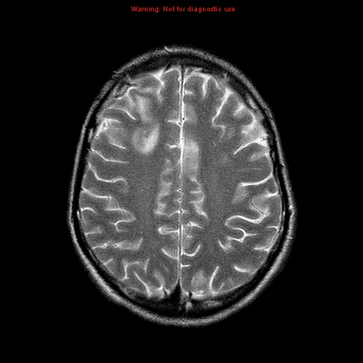 File:Central nervous system vasculitis (Radiopaedia 8410-9235 Axial T2 18).jpg
