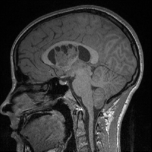 Central neurocytoma (Radiopaedia 37664-39557 Sagittal T1 51).png