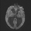 Central neurocytoma (Radiopaedia 56690-63469 Axial DWI 47).jpg